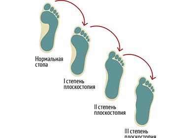 Признаки плоскостопия у детей — симптомы и виды заболевания, диагностика, методы лечения
