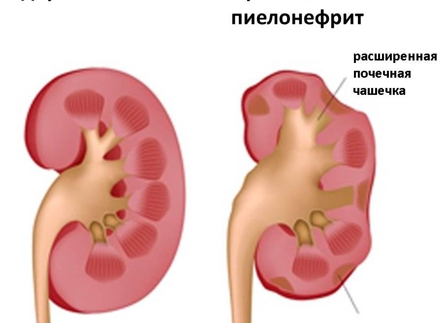 Симптомы и методы диагностики пиелонефрита
