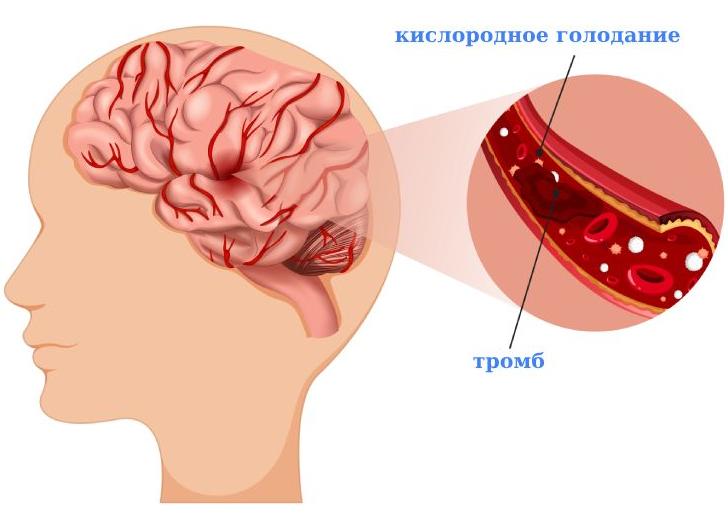 Как лечить инсульт головного мозга