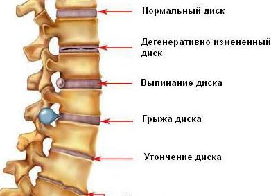 Остеохондроз пояснично-крестцового отдела позвоночника: лечение и отзывы