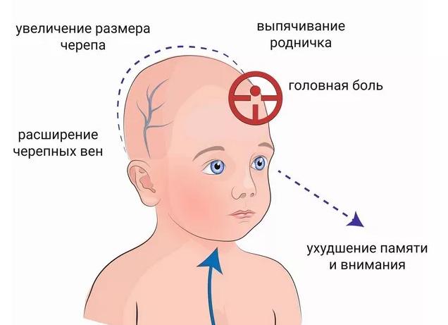 Повышенное внутричерепное давление у грудничков и младенцев — причины, симптомы и лечение