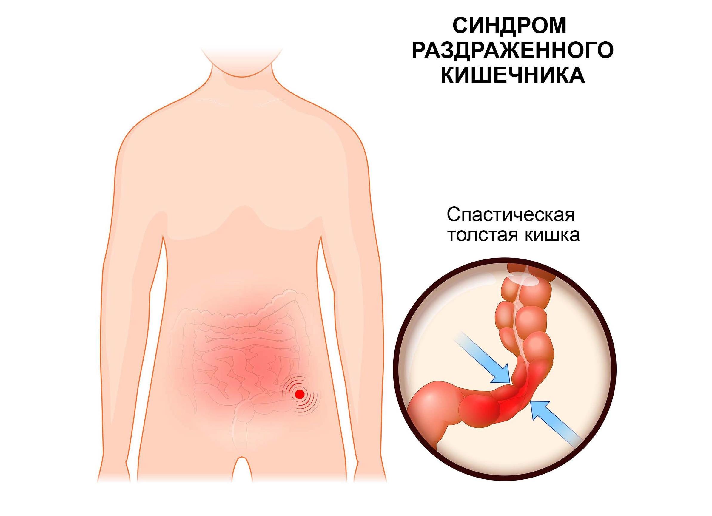 Самые частые причины ложных позывов к дефекации