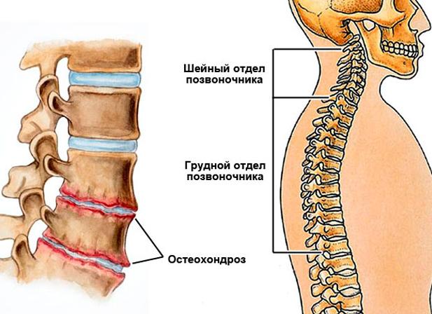 Узнаем, чем опасен остеохондроз?