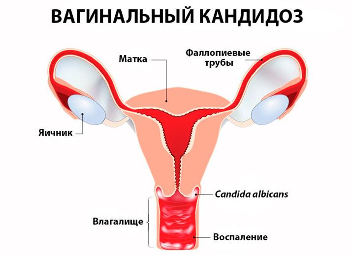 Грибковые инфекции у женщин — причины возникновения, симптомы, локализация, диагностика и лечение