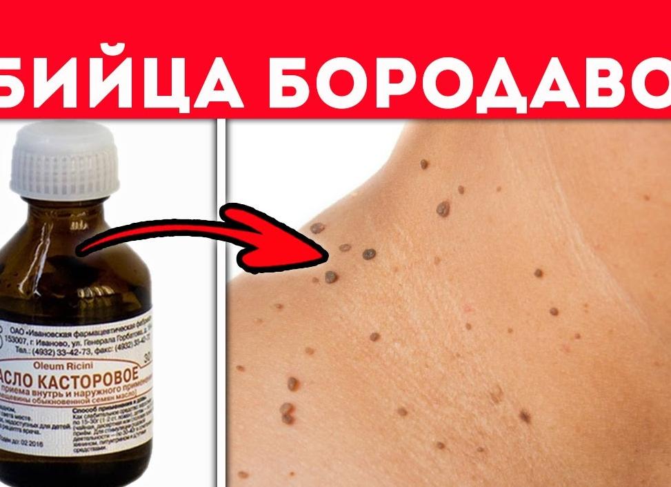 Касторовое масло от бородавок