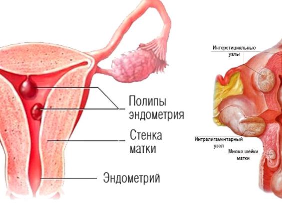 Полипы в матке — причины возникновения, диагностика и лечение