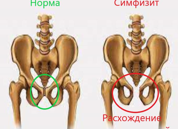Симфизит при беременности – что это такое, причины и степени расхождения лонного сочленения, методы лечения