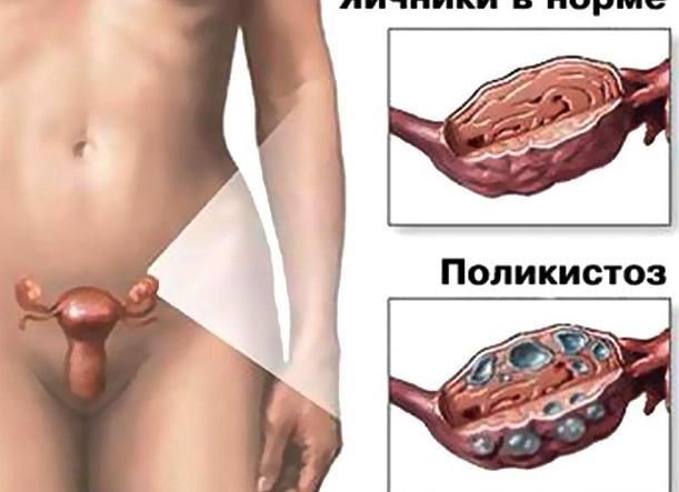 Симптомы поликистоза яичников у женщин