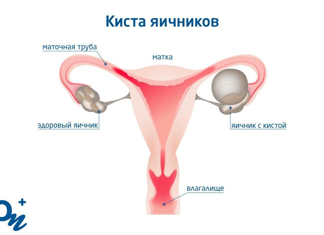 Может ли киста яичника рассосаться сама