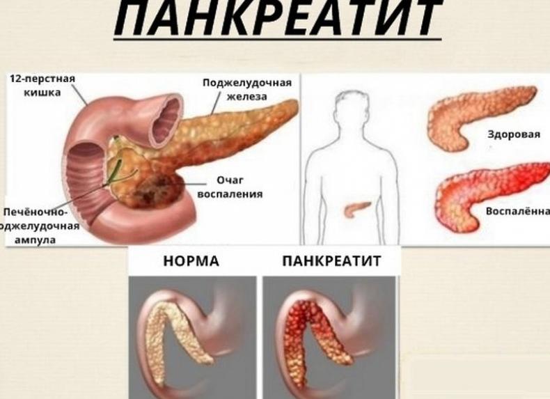 Обострение воспаления поджелудочной железы — основные симптомы и методы лечения