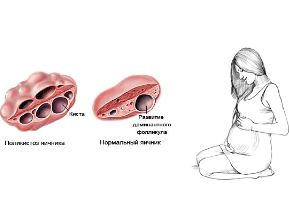 Поликистоз яичников и беременность