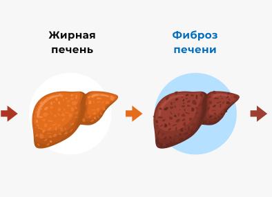 Прогноз при циррозе печени: продолжительность жизни и стадии заболевания
