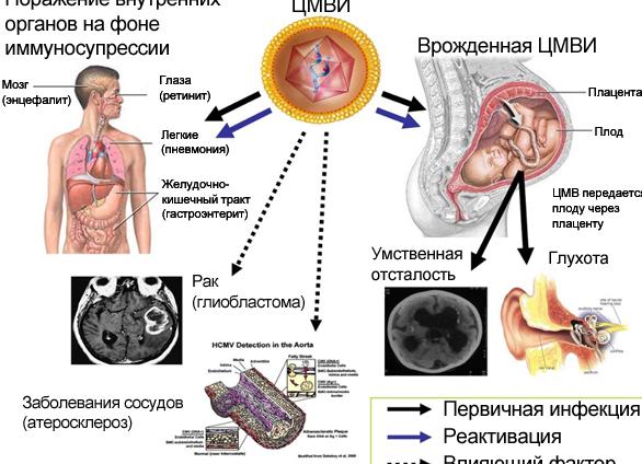 Цитомегаловирус у детей — пути заражения, симптомы, диагностика, методы лечения, последствия и профилактика