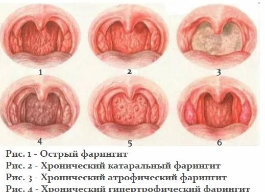 Чем лечить фарингит у взрослых