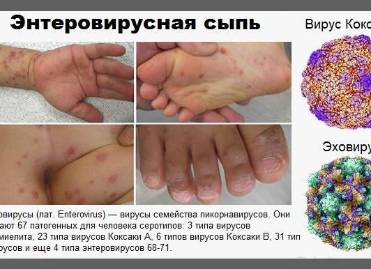 Энтеровирусная инфекция — возбудитель и пути передачи, симптомы, диагностика, методы лечения и профилактика