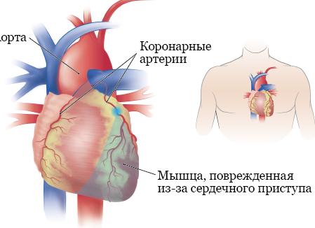 Гипертоническая болезнь сердца — провоцирующие факторы, проявления и схема лечения