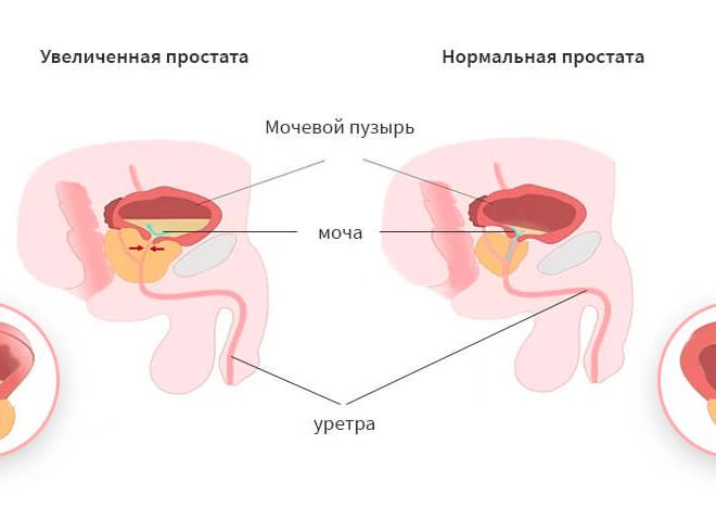 Медикаментозное лечение аденомы предстательной железы