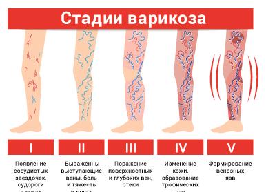 Признаки варикоза ног