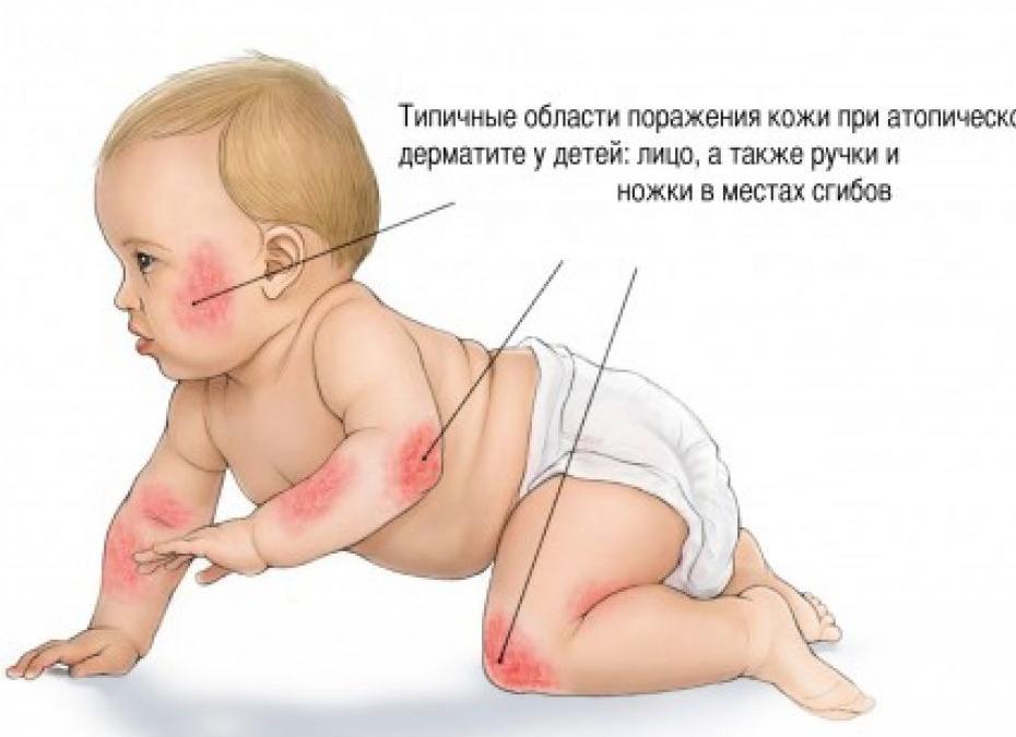 Аллергический дерматит у детей — причины, диагностика и лечение
