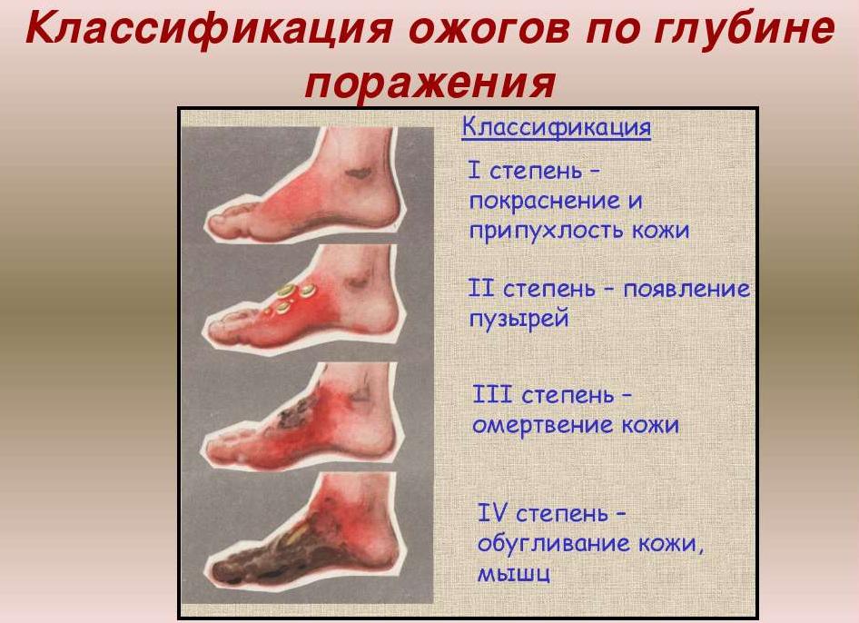 Степени ожогов — виды поражений и алгоритм оказания первой помощи