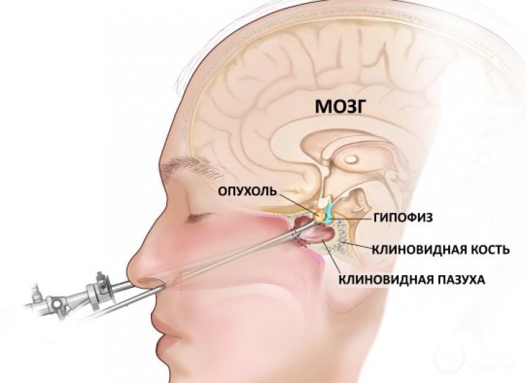 Чем опасна микроаденома гипофиза: симптомы, лечение и последствия