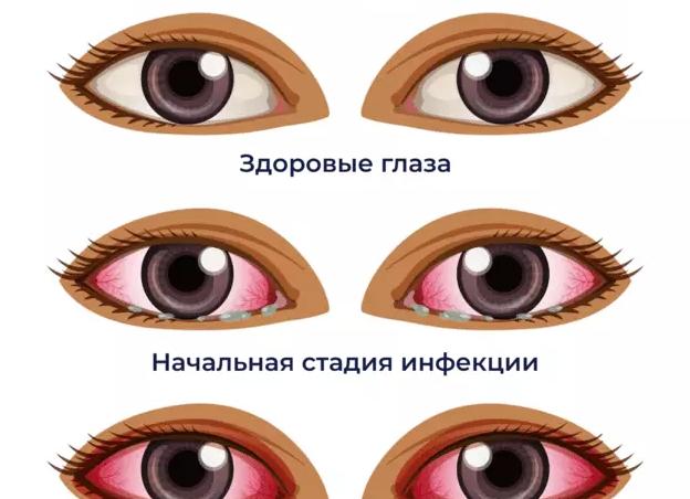Инфекционный артрит — возбудители болезни, симптомы, диагностика