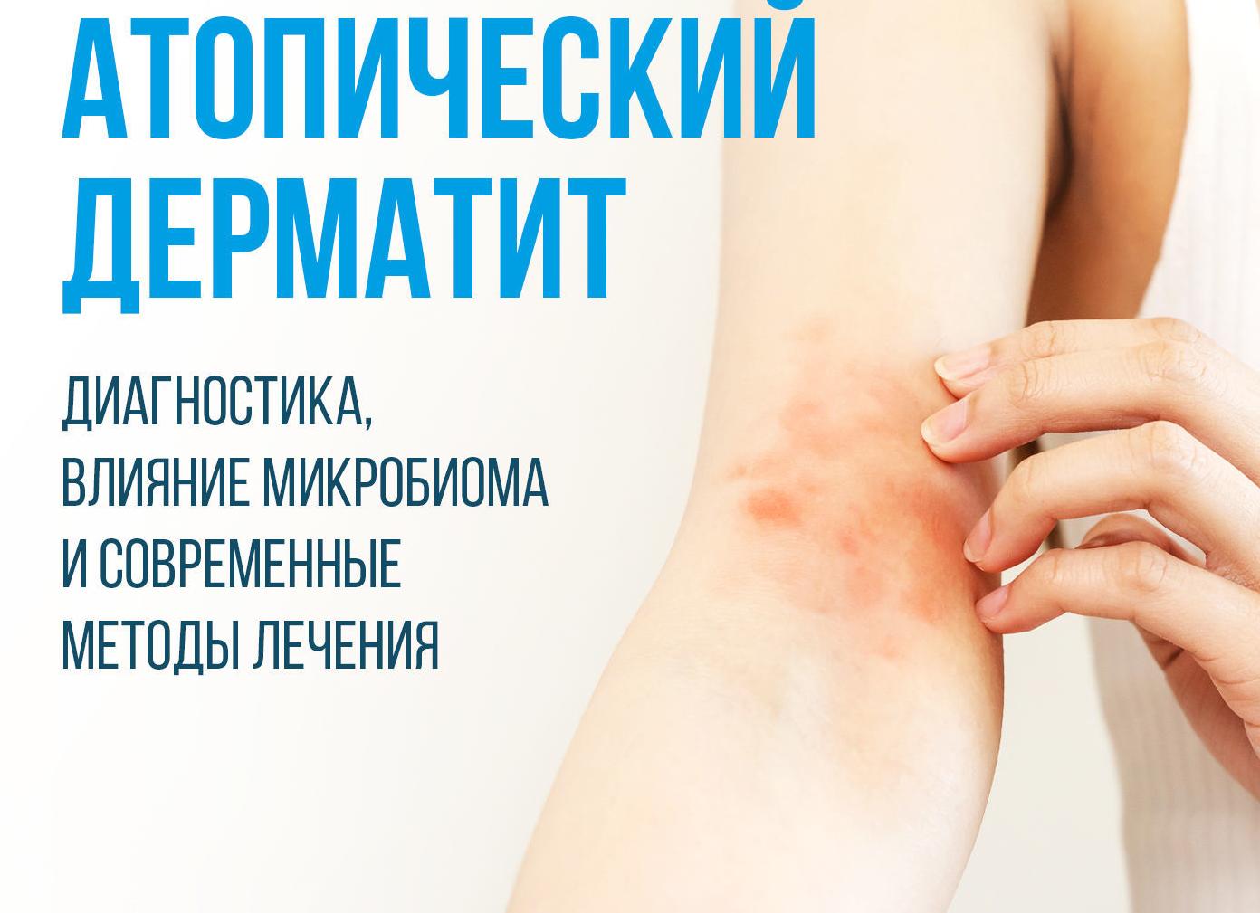 Нейродермит — симптомы и лечение заболевания