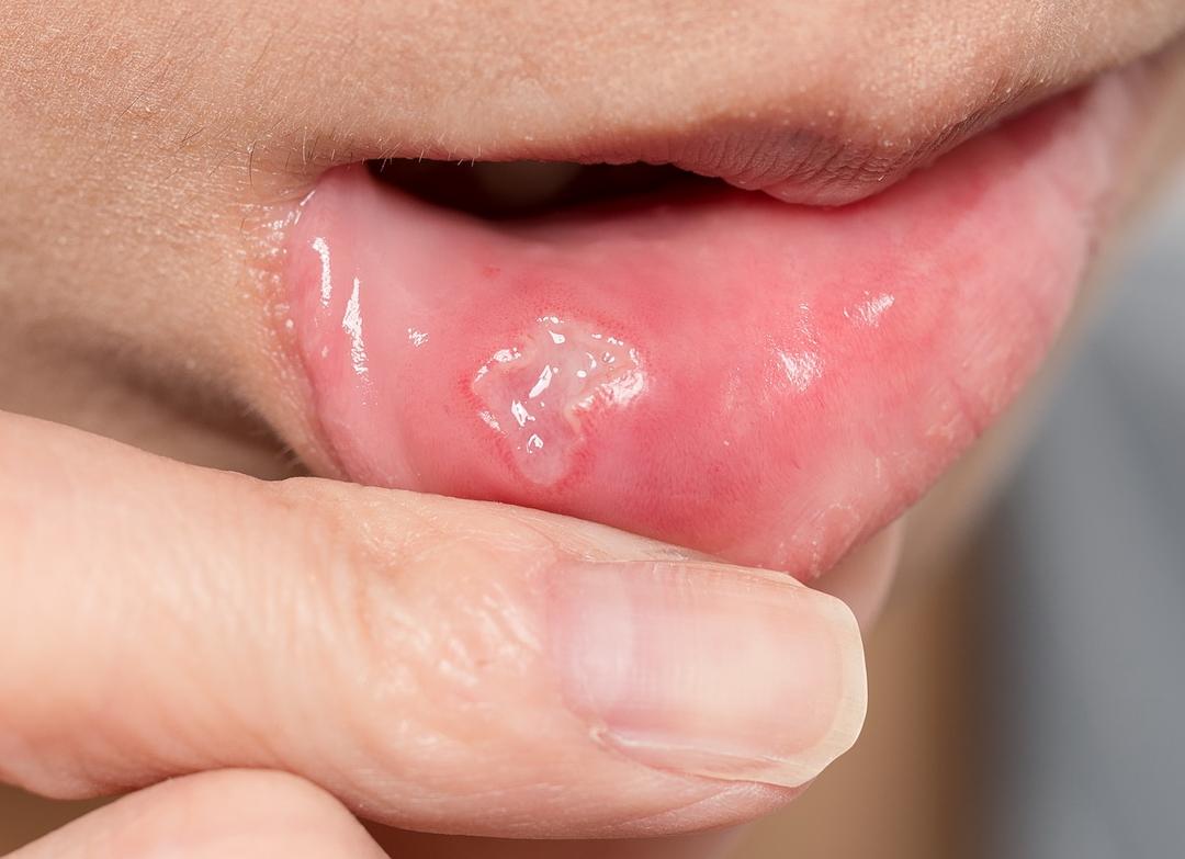 Виды стоматита у детей и взрослых