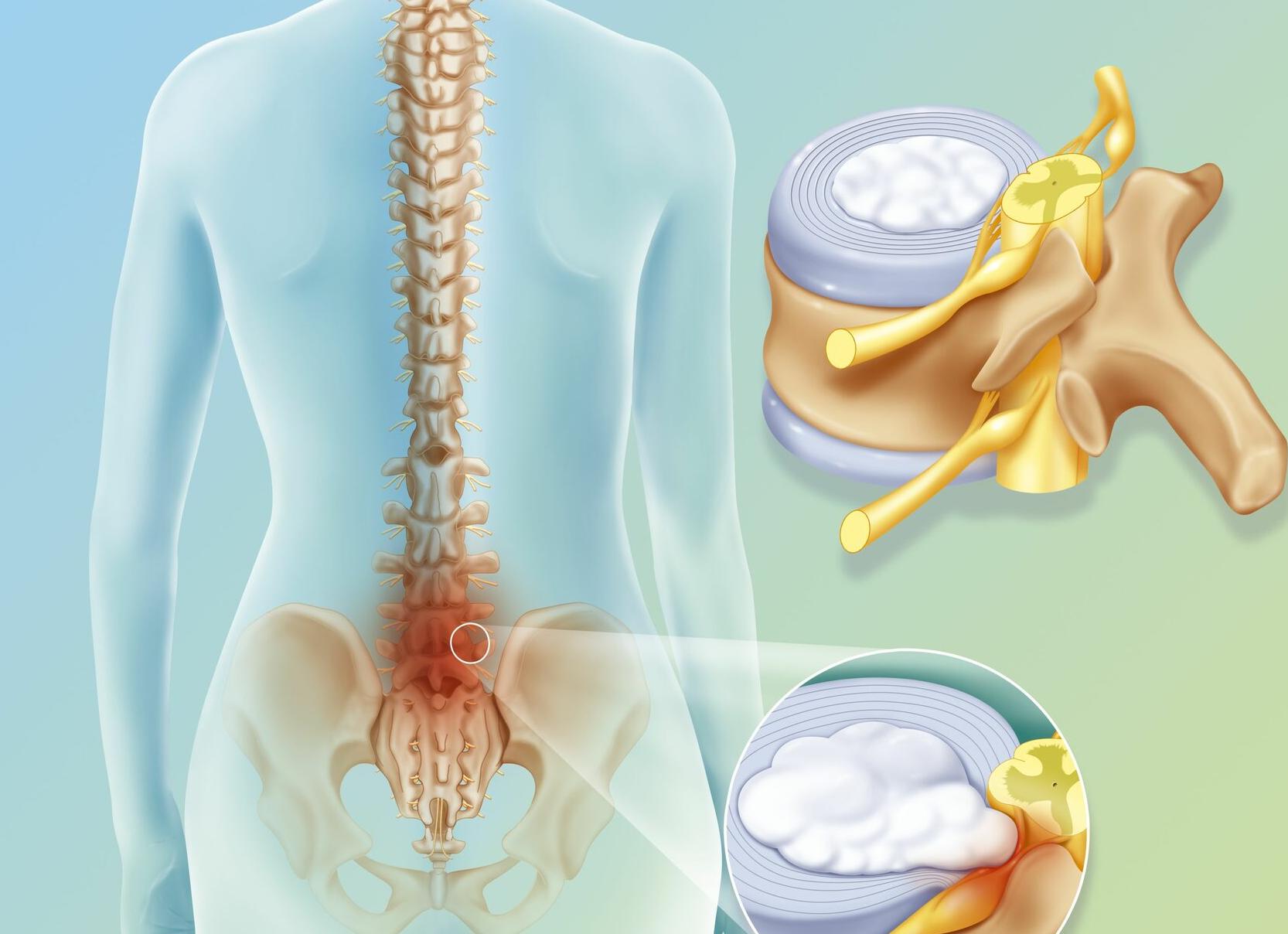 Как лечить протрузию дисков позвоночника поясничного отдела?