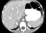 Злокачественная неврогенная опухоль ганглионейробластома