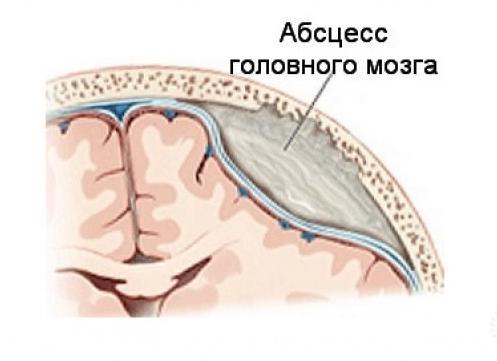 Что такое абсцесс головного мозга и как с ним бороться