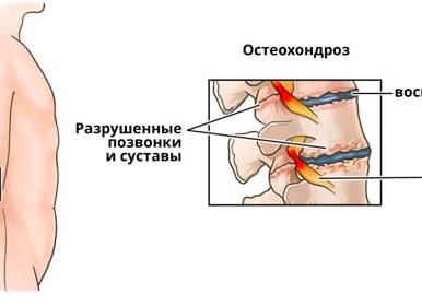 Остеохондроз поясничного отдела позвоночника — лечение и симптомы