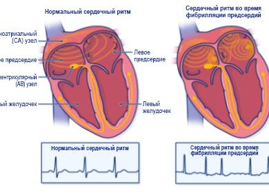 Симптомы, лечение и последствия инсульта левой стороны мозга
