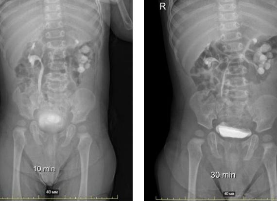 Что такое удвоенная почка и чем это опасно?
